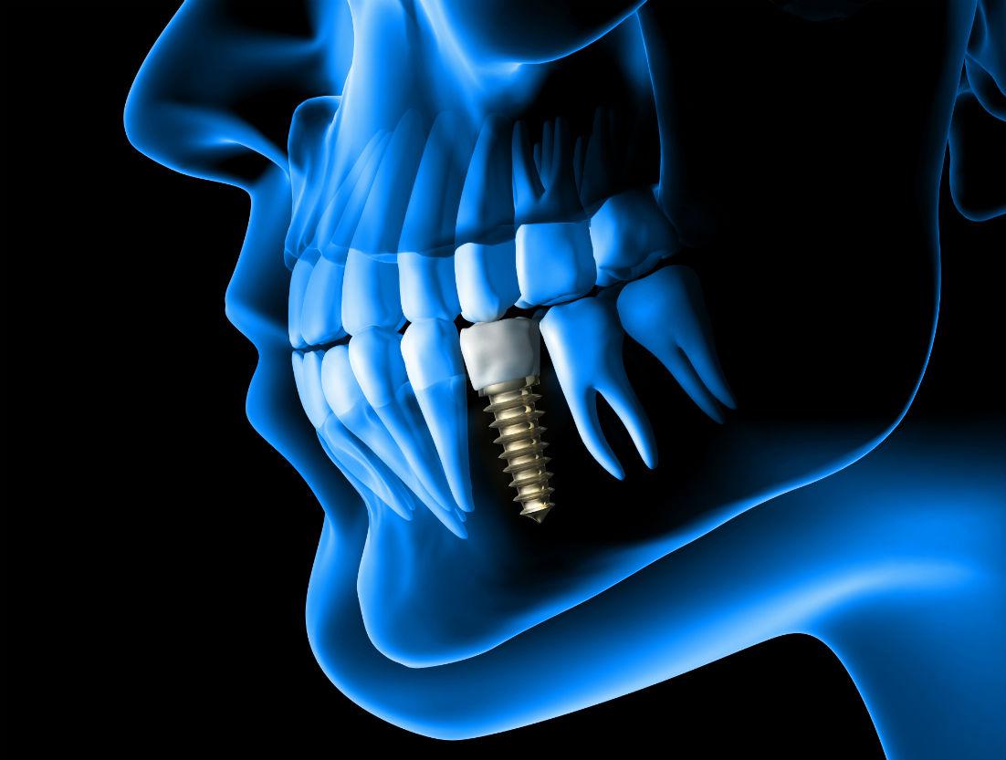 Dental Implants Berkeley, CA